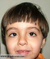 انحراف چشم از علل شایع تنبلی چشم در کودکان